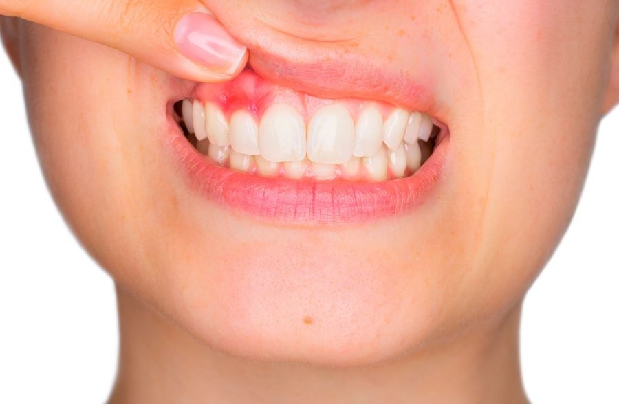Dental Gum Diseas treatment